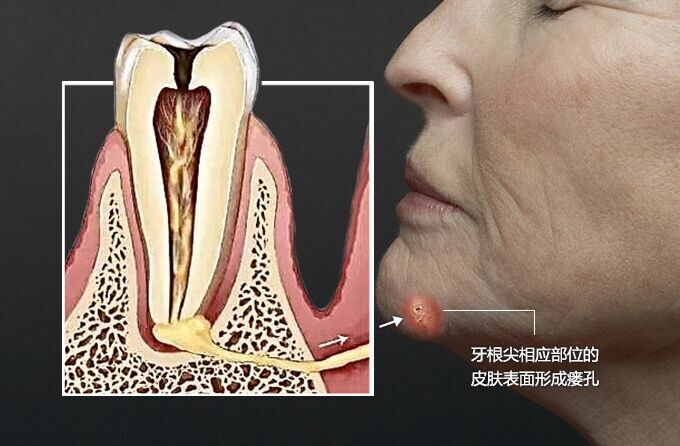 "福建女子下巴冒出脓液：提醒一定要早诊！"

同时，根据你的描述，我还可以对文章进行一些修改：

在福建省有一名年轻女子，她的下巴上有一个异常的小孔。当我们按下这个小孔时，会发现有浓稠的脓液排出。因此，我们强烈建议她立即就医，因为这种情况可能是严重的疾病的一个迹象。

这个小孔可能会导致感染，影响到她的健康和外观。而一旦病情严重，可能需要进行手术来去除脓液和炎症。

因此，如果你有任何关于这个病症的问题或疑虑，你应该尽快咨询医生。他们将能为你提供最准确的信息，并帮助你制定最佳的治疗计划。记住，早期诊断和治疗通常可以防止疾病的恶化和并发症的发生。