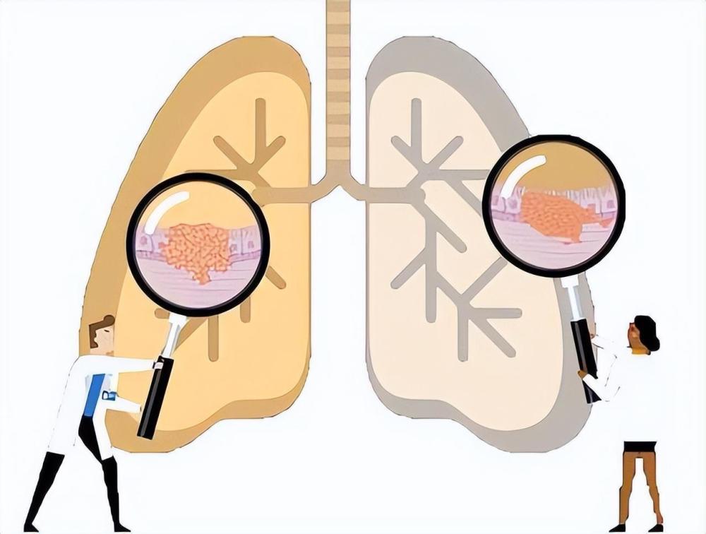 "针对肺结节的初步筛选与注意事项：你的疾病类型在哪？"