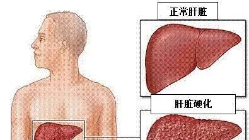 在肝硬化中遵循这三点，逆转并非梦想