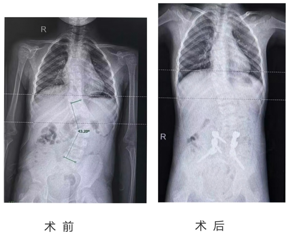 "惊世手术：9小时仅植入6颗钛钉，脊柱侧弯女孩身高瞬间“逆袭”5厘米"