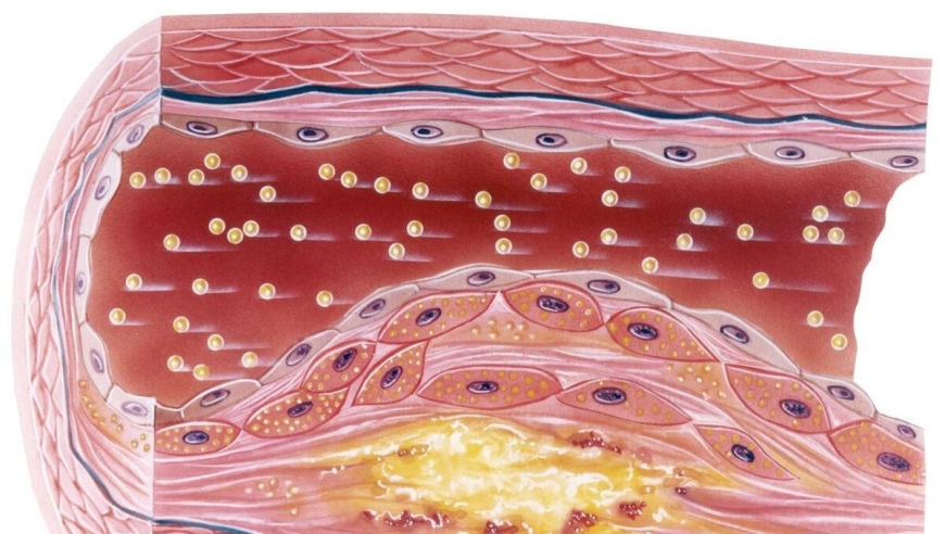 动脉粥样硬化的具体形成过程及其影响因素：一探究竟