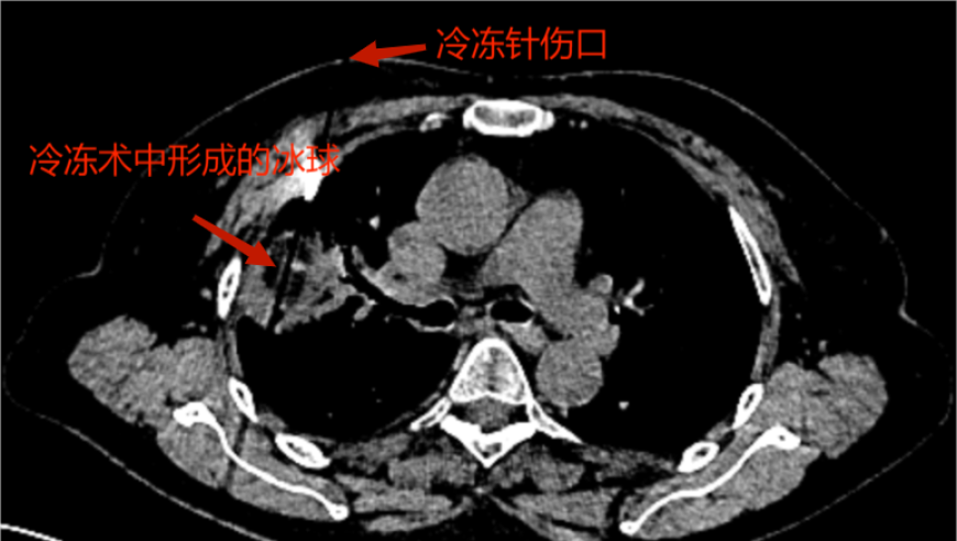 高效液氮冷冻疗法：通过形状似牙签的穿刺针穿透并杀死肿瘤细胞