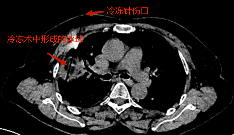 "高效液氮冷冻疗法：通过形状似牙签的穿刺针穿透并杀死肿瘤细胞"