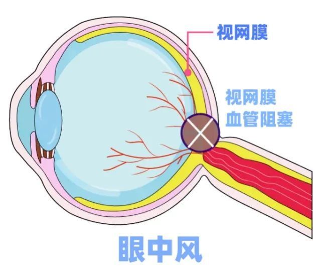 "95后女孩一觉醒来右眼失明，紧急呼吁！错过了最佳救治时机，千万不能忽视——"