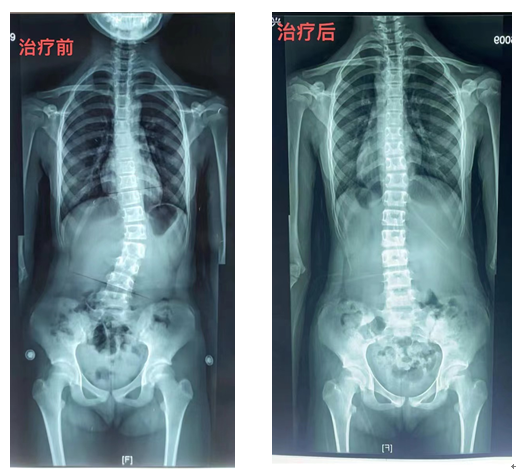 "防止脊柱侧弯：关注孩子的写字姿势问题"