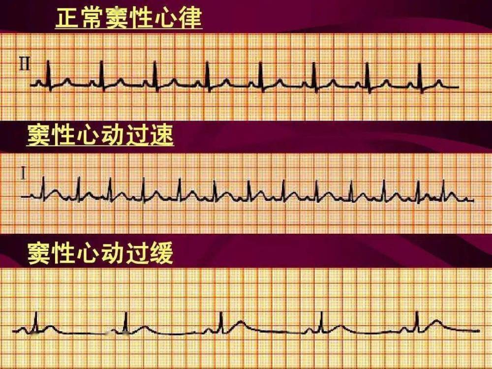 "窦性心律的定义、正常范围以及异常症状：全面解析"