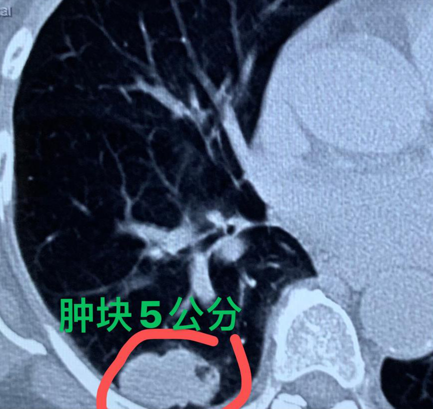 "不速之客：终于查到肺结节已经转移！网络资料中的惊险故事"