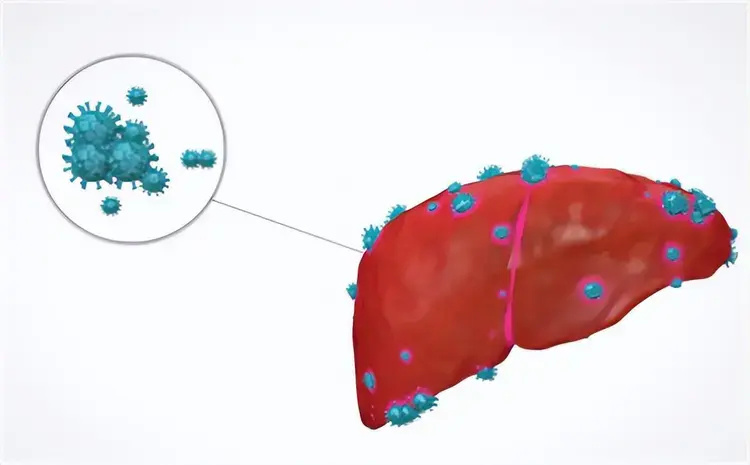 "预防肝癌的五大关键：5个高风险因素和9项必备措施"