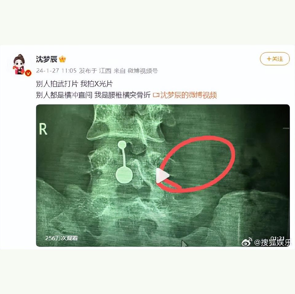 著名主持人的腰椎骨折事件引发网友热议：本人回应00:15