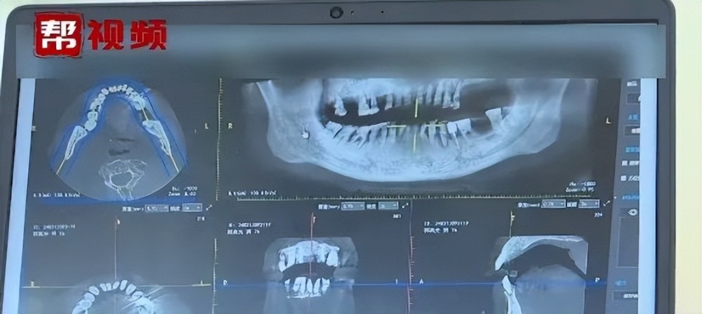 "一个因为烂牙引发的口腔癌案例：不良口腔卫生习惯可能导致癌症风险增加"