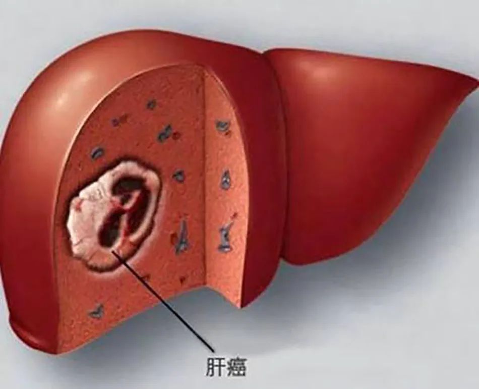 "早期肝癌的必查项目是什么"