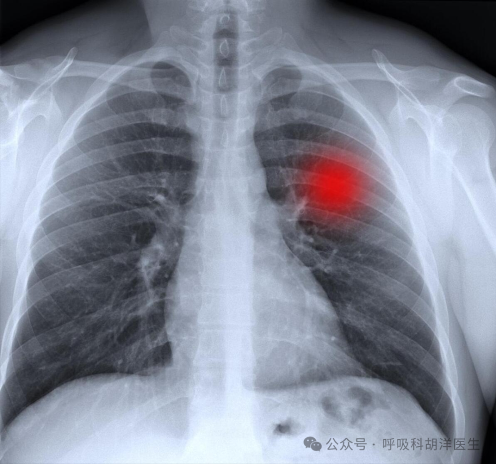 "病痛折磨下的选择：为何肺结节手术前需要穿刺定位？"