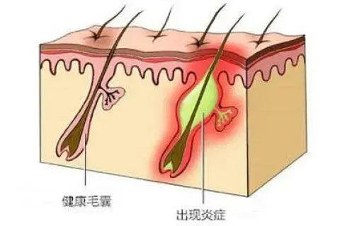 "头皮痒、痛与脱发：一网打尽原因与防范策略"