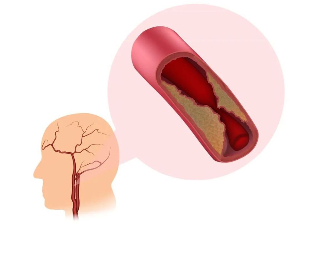 "不容忽视：颈动脉斑块可能威胁生命，千万不要掉以轻心"