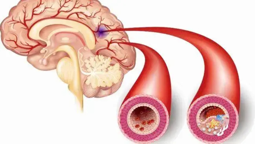 为什么容易出现腔隙性脑梗塞？八个重要信息：了解病因与临床症状