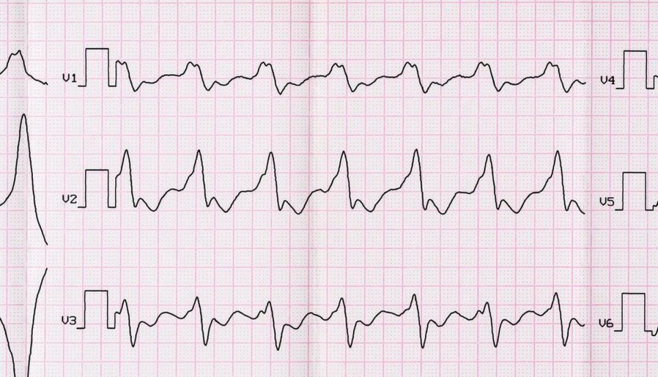 "了解甲状腺结节与心律失常：哪些病状共同引发心脏病的风险?"