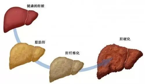 "首都医科大学：早期发现的脂肪肝，潜在风险提升52%"