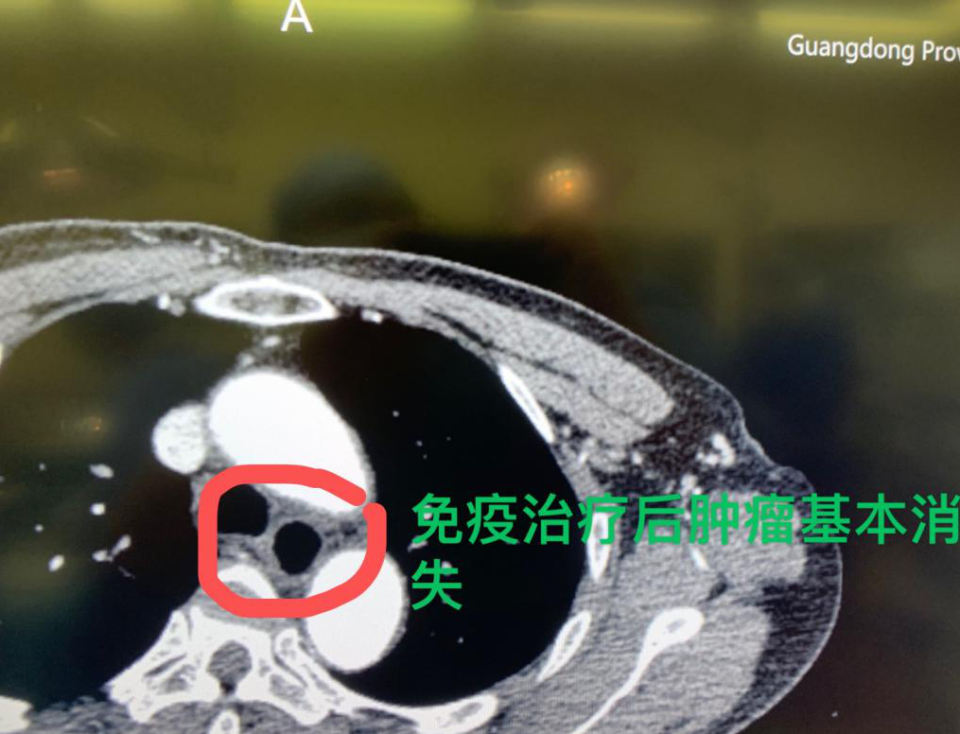 "隐藏在知识海洋中的强大肿瘤：这位63岁老教师是如何战胜的？"