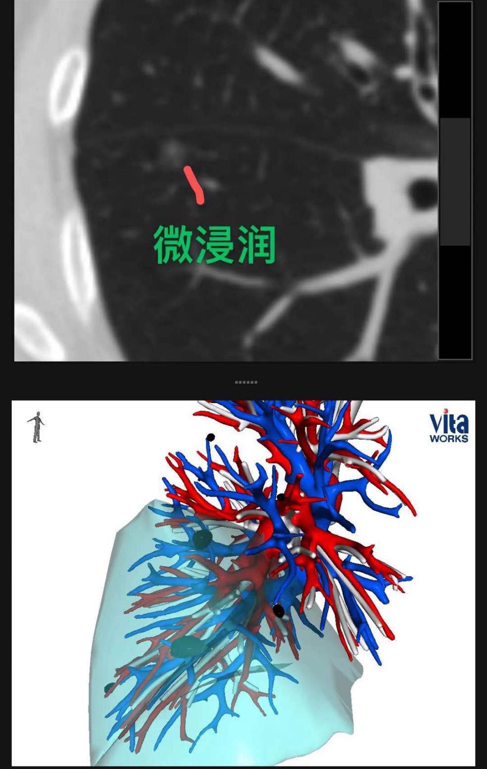 "双肺多发结节！患者奔溃：我的肺都“烂透”了——详细解析结节背后的真相"