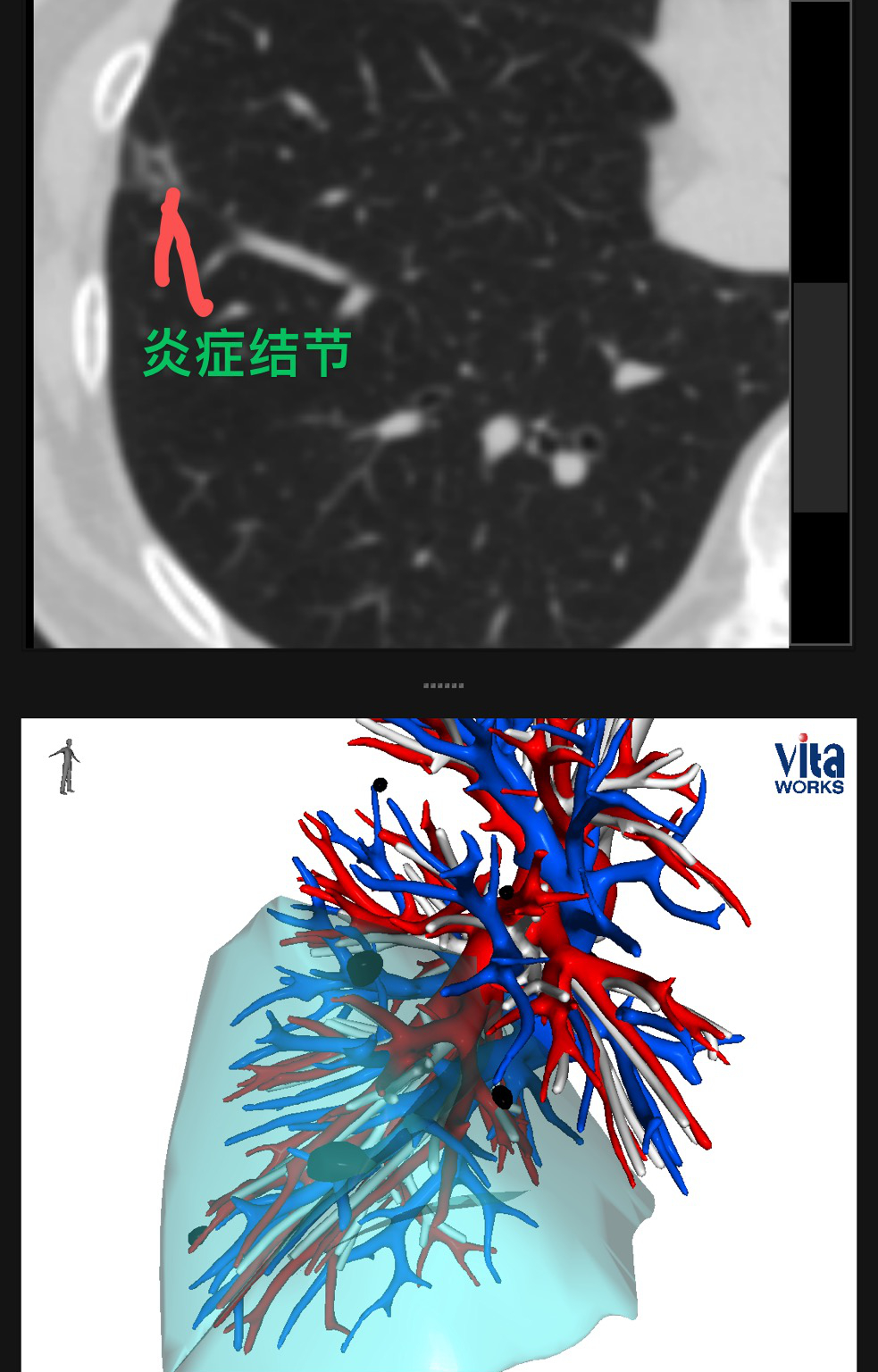 "双肺多发结节！患者奔溃：我的肺都“烂透”了——详细解析结节背后的真相"