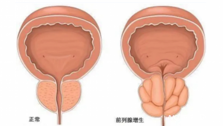 健康资讯：给老年人缓解排尿难题的5分钟水蒸气消融治疗法