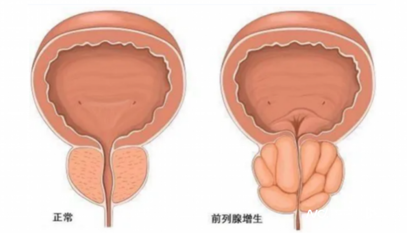 "健康资讯：给老年人缓解排尿难题的5分钟水蒸气消融治疗法"