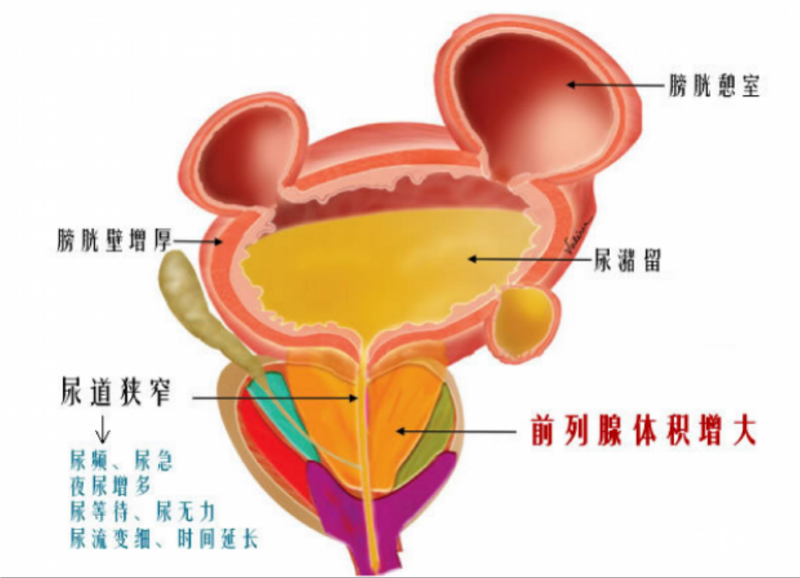 "健康资讯：给老年人缓解排尿难题的5分钟水蒸气消融治疗法"