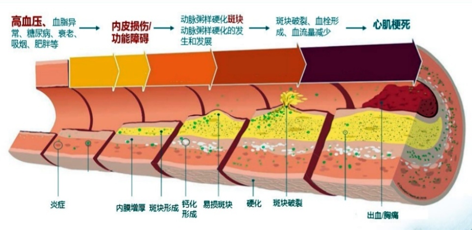 "关于高血压和冠心病的医疗问题：降低血压至130/80mmHg以下的必要性"