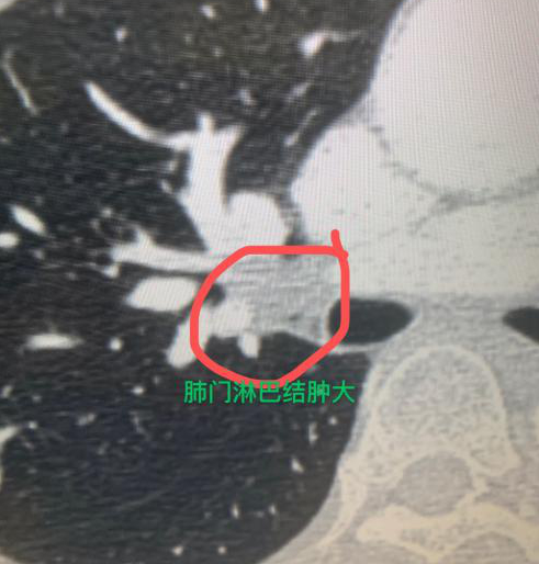 "肺磨玻璃结节的长期跟踪：两年多后医生却发现它已非早期预警"