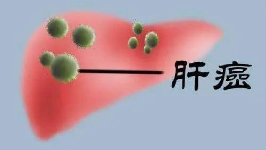 早期识别肝癌的五种常见症状：「拖出来的」并不是全部