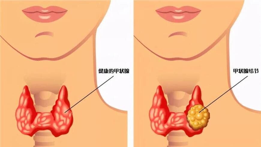 逆转病魔：摆脱甲结的困扰与挑战，你的甲状腺健康从此无忧