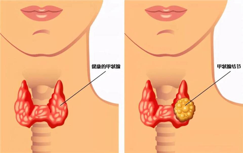 "逆转病魔：摆脱甲结的困扰与挑战，你的甲状腺健康从此无忧"