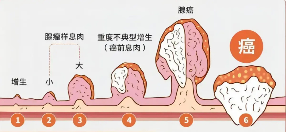 "注意！别忽视小肠息肉！早期发现很重要，谨防肠癌发生"