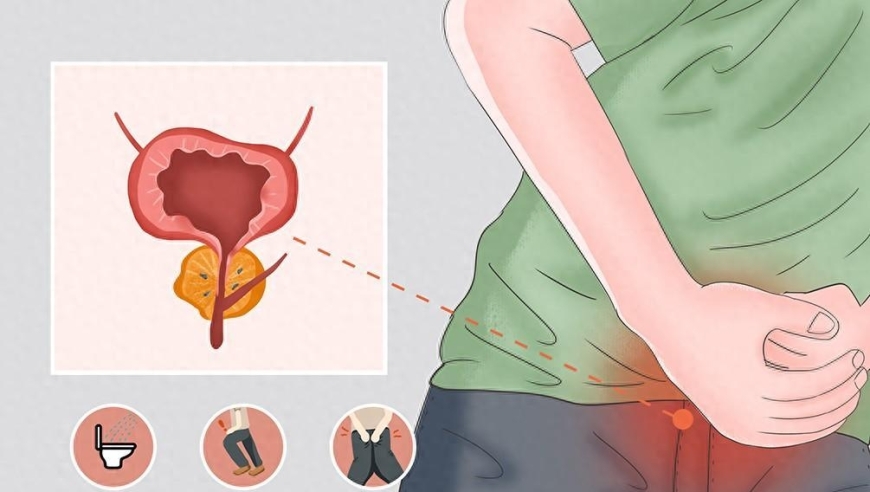 保护前列腺，别让尿频尿急夜尿频繁，警惕前列腺结石？定期检查是关键！六项早期筛查让你早发现疾病。
