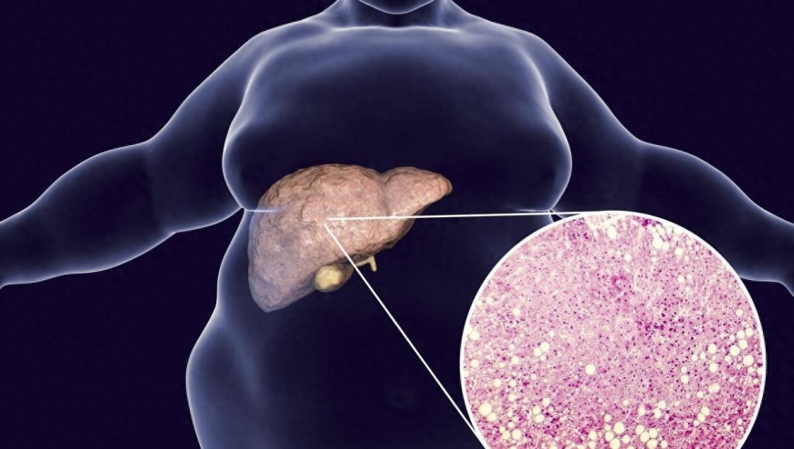 为您揭示脂肪肝的危害及对策，健康肝脏从这4个方面入手