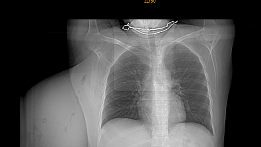 深圳女子乳腺肿物疑似良药？偏方实害无穷：耽误诊疗良机的后果需警惕