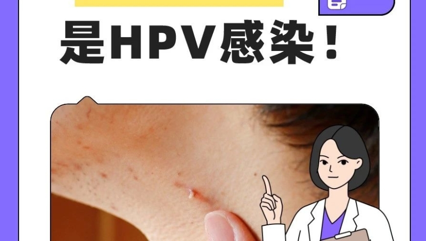 警惕身体不适！HPV感染可能隐藏在你的‘毛刺’里