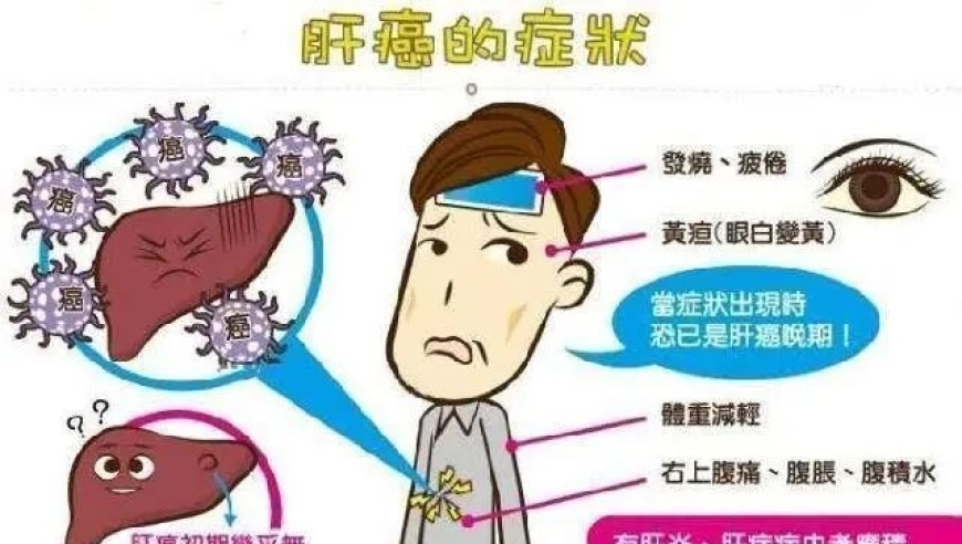 在肝癌早期信号出现前的4个器官：如何提前识别并防范？