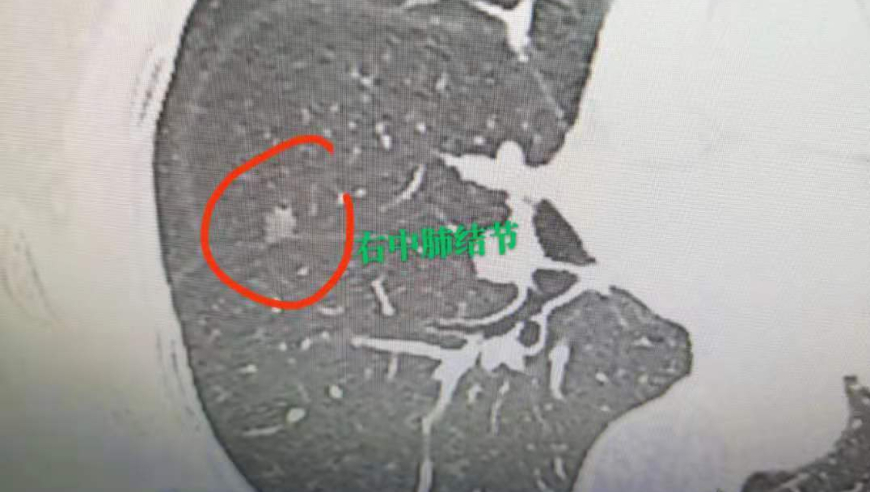 呼吸骤停：如何识别并处理‘肺结节’？