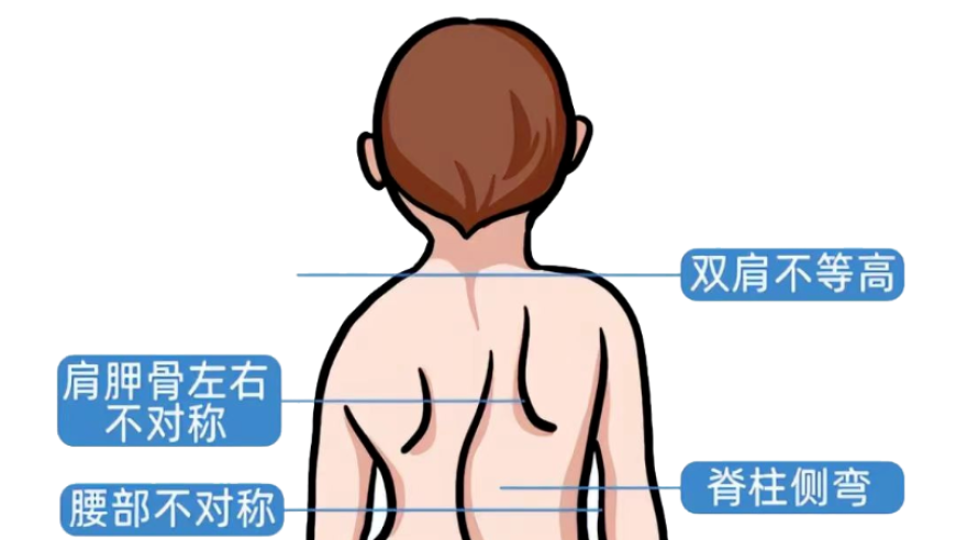 暑期科学提示：如何让孩子拥有健康体态，避免脊柱侧弯的风险