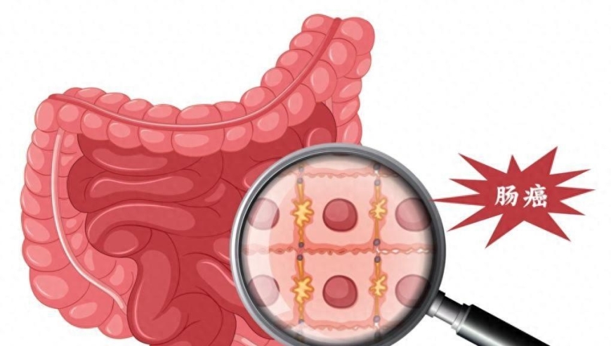 肠癌初期无明显症状？及时发现并筛查肠道健康！正确预防肠道癌!