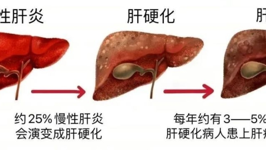 关键词相关性：肝硬化、癌症、知识点、重要提醒