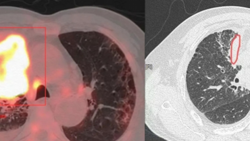 肺部癌症患者的病情有望显著改善，实现肿瘤进展或死亡风险的近一半变革