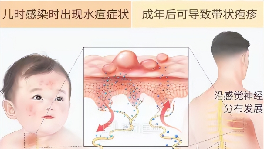 那英患病消息曝光，腰痛并非唯一症状，带状疱疹引发痛感升级?