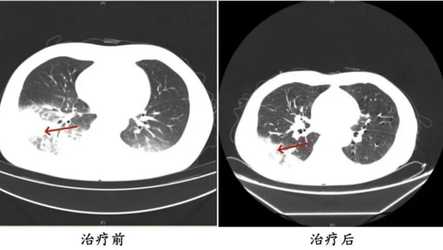 男子长时间未洗空调致肺部感染危及生命：警告用户定期清洗空调