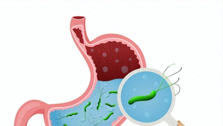 有效防范幽门螺杆菌感染，降低胃癌风险，了解五个关键传播途径