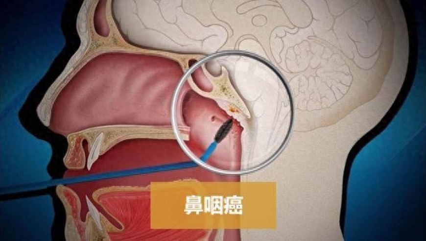 牢记eb病毒风险，及时进行病毒筛查——早期发现至关重要！