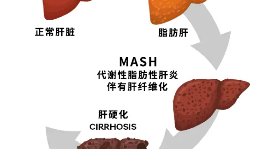 北京大学最新研究成果揭示，五点后不吃晚饭可有效预防脂肪肝