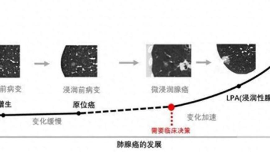 重要提示：发现肺结节无需立即手术，要了解这些要点