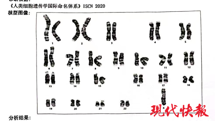 男孩女孩都可能得的罕见病！一女孩因身材矮小被诊断出罕见疾病